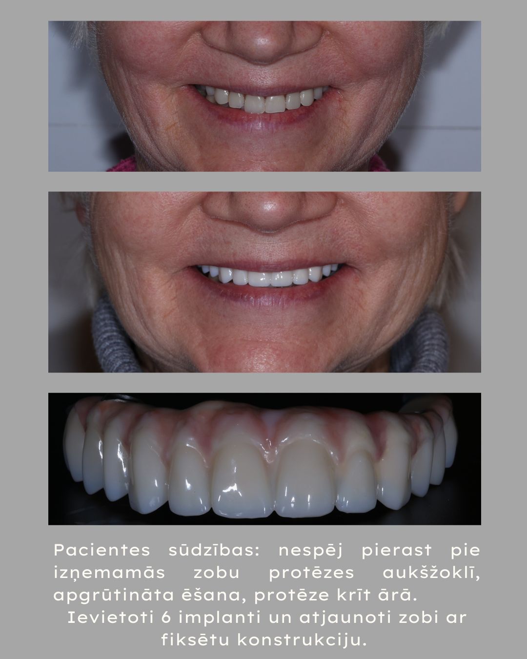 implanti1