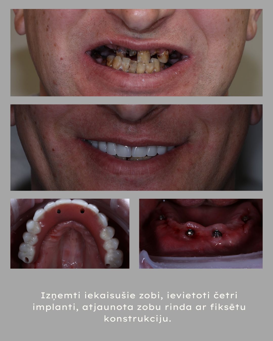 vissuzimplantiem